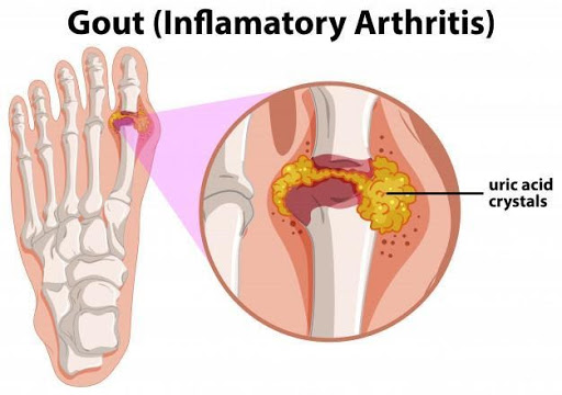 Gout - inflamatory arthritis