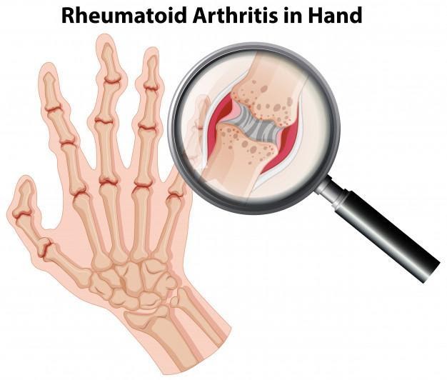 rheumatoid arthritis