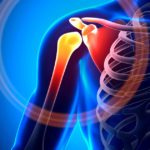 fibromyalgia-pain-avacen